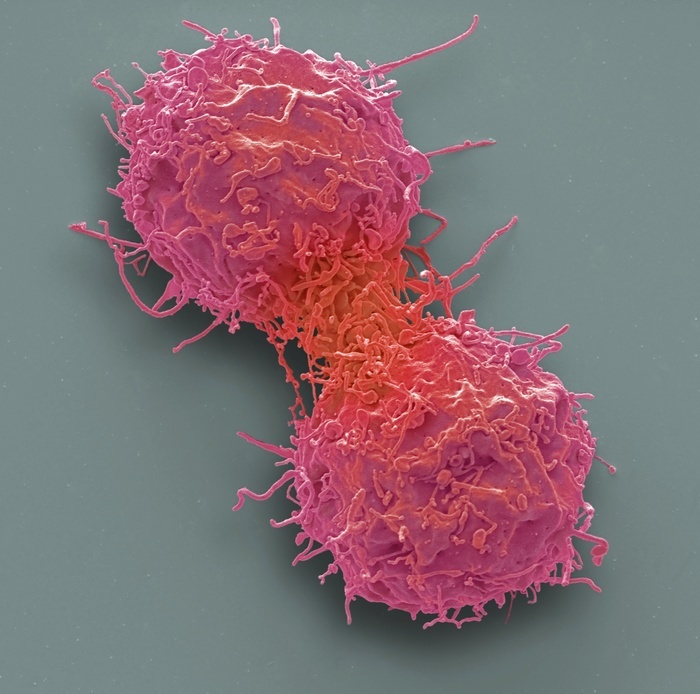 Dividing leukaemia cell, SEM Dividing leukaemia cell. Coloured scanning electron micrograph  SEM  of a dividing leukaemic  cancerous  t lymphocyte white blood cell derived from a patient with acute t cell leukaemia  T ALL . Leukaemia is a type of cancer that affects the bone marrow and white blood cells  leucocytes , disrupting the levels of normal, healthy blood cells and resulting in damage to the immune system  among other symptoms . Possible treatments include anti cancer drugs, radiotherapy and bone marrow transplants. Magnification: x8000 when printed at 10 centimetres wide. Specimen courtesy of Greg Towers, University College London, UK. Photo by STEVE GSCHMEISSNER SCIENCE PHOTO LIBRARY