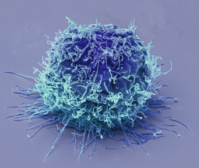 Leukaemia cell, SEM Leukaemia cell. Coloured scanning electron micrograph  SEM  of a leukaemic  cancerous  t lymphocyte white blood cell derived from a patient with acute t cell leukaemia  T ALL . Leukaemia is a type of cancer that affects the bone marrow and white blood cells  leucocytes , disrupting the levels of normal, healthy blood cells and resulting in damage to the immune system  among other symptoms . Possible treatments include anti cancer drugs, radiotherapy and bone marrow transplants. Magnification: x8000 when printed at 10 centimetres wide. Specimen courtesy of Greg Towers, University College London, UK. Photo by STEVE GSCHMEISSNER SCIENCE PHOTO LIBRARY
