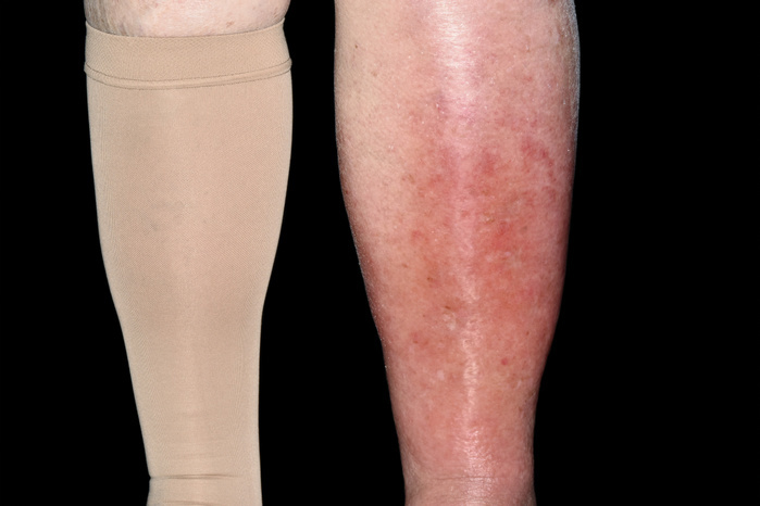 Cellulitis of the leg Cellulitis of the leg. Close up of the legs of an 88 year old woman showing swelling of left leg  right  due to cellulitis. Cellulitis is a bacterial infection of the skin and its underlying tissues. Photo by DR P. MARAZZI SCIENCE PHOTO LIBRARY