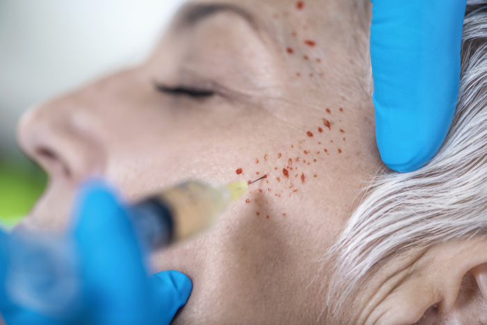 Platelet rich plasma facial treatment Platelet rich plasma facial treatment. Close up of mature woman receiving platelet rich plasma injections for reducing wrinkles.