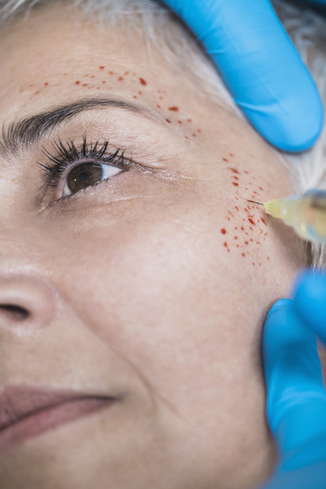 Platelet rich plasma facial treatment Platelet rich plasma facial treatment. Close up of mature woman receiving platelet rich plasma injections for reducing wrinkles.