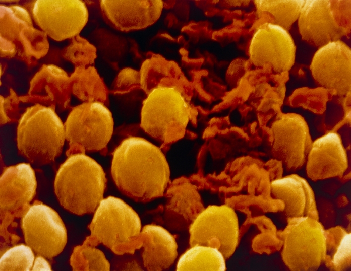 False-colour scanning electron micrograph (SEM) showing the effect of an antibiotic on the bacterium Staphylococcus aureus. Here, the field of roughly spherical bacteria is scattered with the remains of cocci destroyed by lysis (bursting) Lysis is achieved by the destruction of the outer cell wall and the subsequent release of the intracellular contents into the surrounding medium. S. aureus is a Gram-positive species of bacteria that is the commonest cause of pyogenic (pus-forming) infections in humans. It has evolved a number of variants resistant to antibiotics. Magnification: x12,000 at 6x7cm size, x6,000 at 35mm size.
