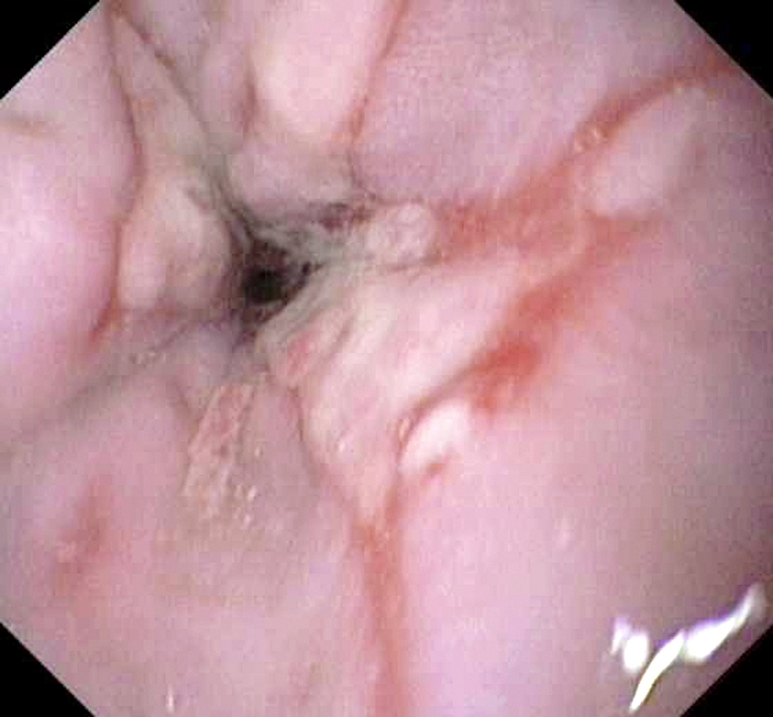 Ulcerated oesophagus. Endoscopic view of the damaged lining of an oesophagus (gullet) in a person affected by gastrooesophageal reflux disease (GORD). GORD (reflux oesophagitis) occurs when stomach contents leak back (reflux) into the oesophagus. The acid in the stomach contents damages the mucosal layer (lining) of the oesophagus. This can cause heartburn, necrosis (death) of the mucosal cells, and ulcers. GERD occurs when the lower oesophageal sphincter, which normally closes off the entrance between the oesophagus and stomach, does not close properly. Treatment is usually with antacids but surgery may become necessary in extreme cases.