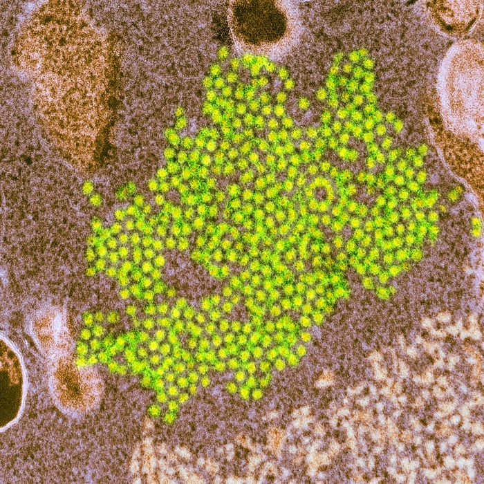 Enterovirus 68 virions, TEM Enterovirus 68 virions, coloured transmission electron micrograph  TEM . Also known as EV68, EV D68 and HEV68, this virus is an enterovirus and a member of the Picornaviridae family. First isolated in California in 1962 and once considered rare, it has become an emerging disease in the 21st century. It has been implicated in cases of a polio like disorder called acute flaccid myelitis  AFM . Enterovirus 68 is related to polio, and is a leading candidate for the cause of the condition.
