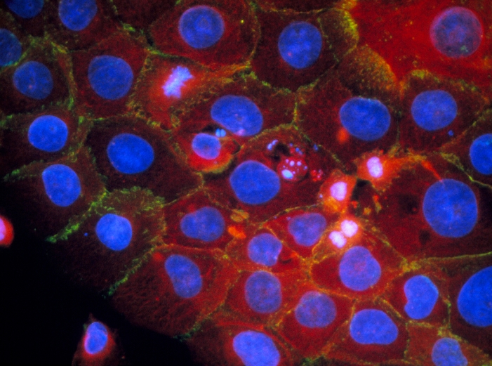 Apoptosis. Immunofluorescent Light Micrograph of a culture of normal human cells, showing apoptosis 'genetically programmed cell death'. Cell nuclei are blue; cytoplasm stains red; the cell membrane is green. At centre, a cell has undergone apoptosis: the nucleus fragments into blobs (blue- white), and the cytoplasm shrinks to form grape- like clusters. These cell remnants have then been eaten by a neighbouring cell (centre). Research on apoptosis may provide genetic treatments for diseases such as cancer. Immunofluorescence uses antibodies to attach fluorescent dyes to cell structures. Magnification: x250 at 5x7cm. x125 at 35mm