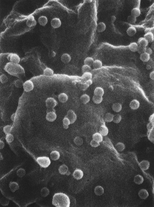 Scanning electron micrograph (SEM) of part of the surface of a T-lymphocyte infected with Human Immunodeficiency Virus (HIV), the causative agent of Acquired Immune Deficiency Syndrome (AIDS). The T-lymphocyte is from a culture cell line known as H9. An Infected T-cell typically has a lumpy appearance with irregular rounded surface protrusions. Small spherical virus particles visible on the surface are in the process of budding away from the cell membrane. Depletion of the population of T4 lymphocytes through HIV infection is the main reason for the destruction of the immune system in AIDS. Magnification: x80,000 at 6x8 inch size.