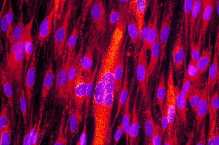 Cytomegalovirus infected cells. Immunofluorescent light micrograph of human fibroblast culture cells infected with cytomegaloviruses. The infected cells are shown by the presence of the virus- specific protein UL37 (orange). Cell nuclei are blue, with mitochondria red. UL37 localizes to the mitochondria, keeping the cells alive for longer and enabling them to produce more viruses. Fibroblasts are found in human connective tissue. They are involved in, among other things, making the fibrous structural protein collagen. In immunofluorescence, fluorescent dyes are attached to specific tissues using antibodies. Magnification: x80 at 5x7cm size.