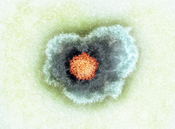 Herpes simplex virus particle, coloured transmission electron micrograph (TEM). Each particle (virion) consists of a deoxyribonucleic acid (DNA) genome surrounded by an icosahedral capsid (orange), which is itself surrounded by an envelope (blue). When the envelope breaks and collapses away from the capsid, negatively stained virions have the typical 'fried-egg' appearance that is seen here. Herpes simplex is one of the most common viral pathogens in humans. It causes inflammation of the skin and mucous membranes, characterized by fluid-filled blisters. Magnification: x156,000 when printed 10 centimetres wide.