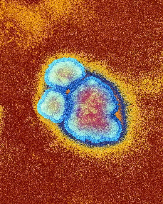 Measles virus Electron microscopic image  Date taken unknown  Measles virus particles. Coloured transmission electron micrograph  TEM  of a virus that causes measles  from the morbillivirus group of viruses . Each particle is surrounded by a lipoprotein envelope, acquired from the host cell s cytoplasmic membrane as the virus buds off from the cell surface. The envelope is studded with surface proteins and encloses the nucleocapsid: a helical structure consisting of a single stranded ribonucleic acid  RNA  core  genetic material . Measles is highly infectious and mainly affects children, producing fever and rash. One attack usually gives life long immunity. Magnification: x144,000 when printed 10 centimetres high.