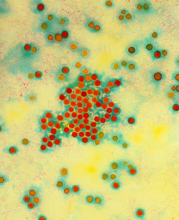 Hepatitis A virus. Coloured Transmission Electron Micrograph (TEM) of a cluster of Hepatitis A virus particles, the cause of infectious hepatitis. Viruses particles are small red circles made of a protein coat encapsulating RNA-genetic material. These viruses are similar in structure to the Picornavirus group (which includes enterovirus and rhinovirus). During Hepatitis A infection, the virus attacks the liver producing liver inflamma- tion, fever and jaundice. Hepatitis A is transmitted by water or food contaminated with infected faeces. The disease is more prevalent in warm countries with poor standards of hygiene. Magnification: 56,000 at 6x7cm size. Magnification: 187,000 at 8x10' size.