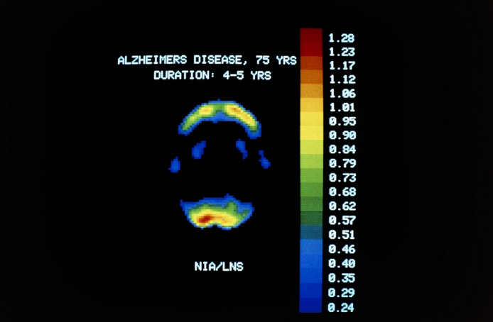 PET scan (positron emission tomography) of the brain of a person suffering from Alzheimer's disease, a progressive form of dementia. This subject, aged 75 years, has had the disease for 4- 5 years. PET scans utilise radioactive chemicals, analogues of substances participating in the brain's metabolism, to give an image that represents its level of function. Gamma rays emitted during the annihilation of positrons from the tracer are recorded & colour-coded according to intensity. Here, activity is confined to the top & bottom of the brain; dark blue/black areas represent virtually no activity. Compare with P332/124, same style of scan but of normal subject.