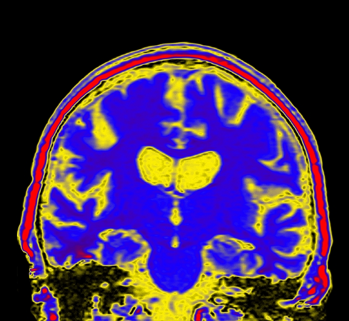 Alzheimer's disease. Coloured magnetic resonance imaging (MRI) scan of a coronal (vertical) section through a brain with Alzheimer's disease. In this condition there is widespread destruction of brain tissue leading to abnormally deep folding and shrinkage of the brain (blue). Two of the brain's fluid-filled ventricles (yellow, centre) have become enlarged. The disease leads to memory loss and disorientation, and is the most common cause of senile dementia. Alzheimer's disease has no known cause and there is no cure. MRI scanning uses a magnetic field and a radio wave pulse to produce 'slice' images of the body.