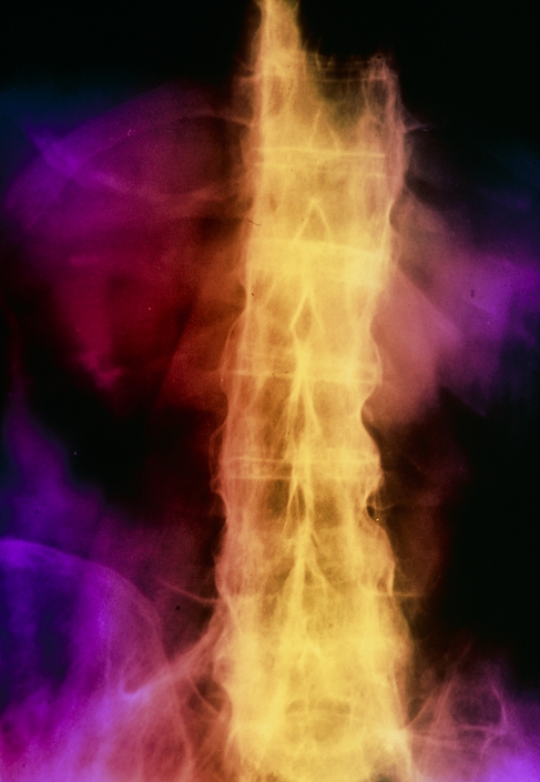 colour X-ray of the lumbar and sacral spine in ankylosing spondylitis (A.S.), a chronic inflammatory arthritis of the spine and sacro- iliac joints, which connect the sacral spine to the pelvis. Inflammation begins in the sacro- iliac joints or lumbar spine, & may progress up the spine. In this severe case, the vertebrae have become fused, giving the 'bamboo spine' appearance. The neck & hips may also be affected. Pain and stiffness are treated with anti- inflammatory drugs & spinal mobility preserved through physiotherapy & regular exercises.