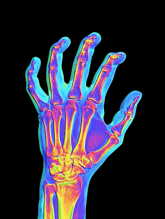 Arthritic hand. Computer-enhanced X-ray of the hand of a patient with osteoarthritis. Osteoarthritis is a degenerative disease that results in the loss of cartilage between joints, in this case between the joints of the finger bones. The healing process has lead to the growth of Heberden's nodes, small bony growths on the terminal phalanges of the fingers. The nodes cause inflammation and pain, and often skew the fingertips. Treatment is with painkilling drugs.