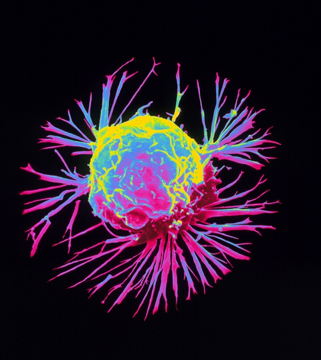 Breast cancer cell. Coloured scanning electron micrograph (SEM) of a single breast cancer cell, showing its uneven surface and cytoplasmic projections. Clumps of cancerous (malignant) cells form tumours, which possess the ability to invade and destroy surrounding tissues and travel to distant parts of the body to seed secondary tumours. Malignant cells proliferate and grow in a chaotic manner, with defective cell division retained within each new generation of cells. Variations also occur in size and structure of the cancer cell from its original cell type. Breast cancer is the most common cause of cancer in women. Magnification: unknown.