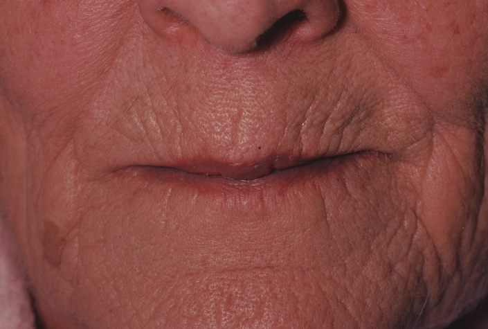 Cyanosis. Elderly woman's lips turned purple due to central cyanosis. The condition of cyanosis is most commonly due to slow blood flow, leading to a bluish skin colouration. There is too much deoxygenated haemoglobin in the blood, with a decreased supply of oxygen to body tissues. Most cases occur in low temperatures, where no other symptoms are present and the condition is harm- less. However, cyanosis may be associated with heart failure, lung disease, and in some instances even lead to suffocation. Blue babies are cyanotic as the result of a heart defect in which too little blood passes into the lungs to be oxygenated.
