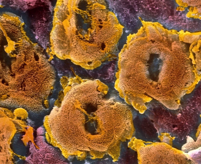 Ulcerative colitis. Coloured Scanning Electron Micrograph (SEM) of the surface of the human colon affected by ulcerative colitis. Inflammation and ulceration of the mucous membrane lining the large intestine occurs in this condition. Here, mucous glands (orange) with their openings are seen. They appear abnormally raised above the mucosa lining (pink), because the outer epithelial layer is absent. Ulceration has destroyed epithelial cells in this area. Ulcerative colitis causes abdominal pain, diarrhoea, and blood loss. The cause often is unknown. Treatment includes drugs and sometimes surgery. Magnification: x1,100 at 6x7cm size. x1,430 at 4x5ins