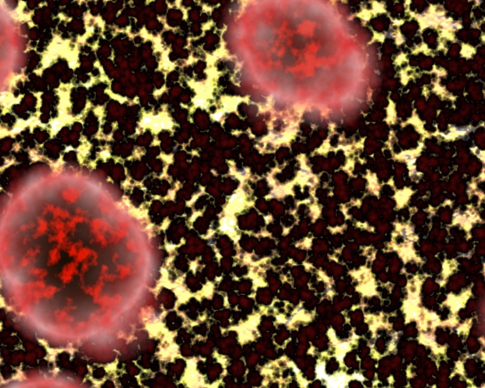 Creutzfeldt-Jakob disease (CJD). computer artwork based on a light micrograph of a section through a human brain exhibiting CJD. Cell bodies of brain neurones (dark red) are surrounded by many white gaps or vacuoles. These are caused by the CJD prion, a virus-like protein. There are three types of CJD: the first appears, apparently without cause, in elderly people; the second affects those who have had transplants from infected people and the third, new variant CJD, is thought to be caused by eating cattle infected by the disease, bovine spongiform encephalopathy (BSE). The symptoms include dementia and myoclonus (sudden muscular contractions. Death occurs within two to three years.