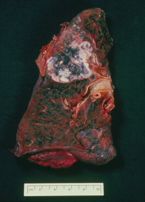 Lung cancer: post-mortem specimen of a human lung revealing a cancerous tumour of the upper lobe. The tumour appears as the black & white mouldy area towards the top of the lung. A history of heavy cigarette smoking is suggested by the appearance of this lung; the entire organ is permeated by black, tarry deposits.