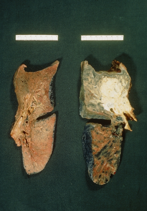 Post-mortem specimens of a sectioned normal lung (left) and a lung destroyed by bronchial cancer. The tumour appears as a white mass in the lower lobe; tissue in the upper lobe is blackened by tar deposits from cigarette smoking. The lung at left shows some blackening, possibly from environmental soot or more moderate cigarette smoking. Cancer of the bronchus arises in many cases from smoking (especially cigarette smoking); there is a marked association between dose (number of cigarettes smoked) and the risk of developing the disease. Mortality in lung cancer is high; the disease has often metastasised (spread) before detection.