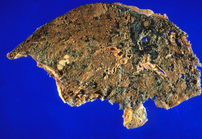 lung cancer Excised section of cancerous human lung, showing rounded deposits of tumour  left, white areas , and widespread cigarette tar deposits  sooty stains . Cancer of the bronchus, more commonly known as lung cancer, is strongly associated with cigarette smoking and exposure to industrial air pollutants. Unfortunately, it is one type of cancer which is least amenable to treatment. Early stage diagnosis is difficult, when no symptoms are present. At the time of diagnosis  usually by chest X ray , the tumour is often well established   has metastasised, that is, spread to other organs such as the liver, spine and brain.