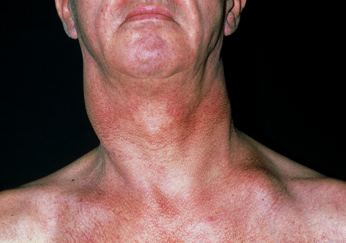 Cancer of lymph node. Swollen lymph node (centre left) in the neck of a 57-year-old man due to cancer. The tumour in the node has spread from a carcinoma of the pharynx (the tube that extends from the oesophagus, or gullet, to the base of the skull). Cancer cells divide rapidly in a chaotic manner. They often form clumps (tumours) that may destroy surrounding tissues and spread to other parts of the body (metastasis). Treatments for cancer include radiotherapy, chemotherapy and surgical excision of affected tissues. The lymph nodes are an important part of the body's defence against infection, preventing foreign particles from entering the blood stream.