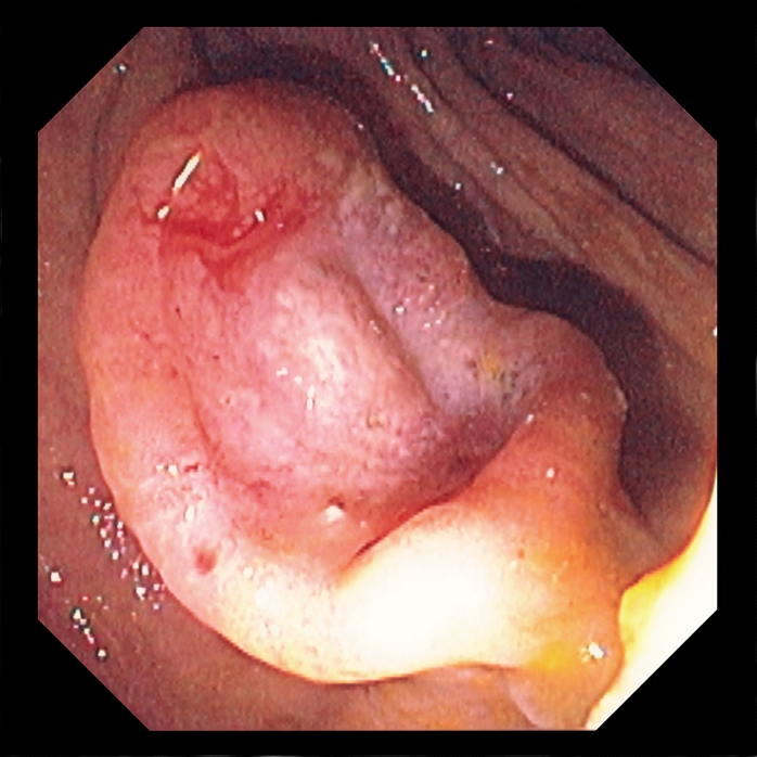 Colon cancer. Colonoscope (endoscope) view of a cancerous sessile lesion (adenocarcinoma) in an 86 year-old man. An adenocarcinoma is a cancer that arises from the glandular tissue of an organ's epithelium (lining). Colon cancer, common in the developed world, is thought to be linked to a high-fat and low-fibre diet. Although the patient suffered anaemia, no bleeding was evident. Diagnosis of the cancer showed it had spread (metastasis) to the liver resulting in a poor prognosis.