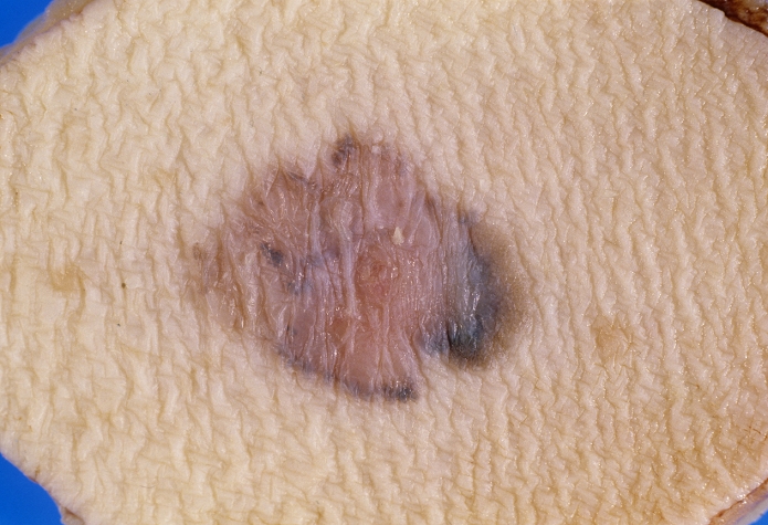 Skin cancer. Gross specimen of a malignant melanoma (dark area), a type of skin cancer. This cancer arises from the skin's melanocytes, the cells that produce the pigment (melanin) that give skin its colour. The main cause of melanoma is exposure to ultraviolet radiation in sunlight. It is an aggressive cancer that often spreads (metastasises) to other parts of the body. Treatment is with surgical removal of the tumour, which can completely cure small tumours. Larger tumours are also treated with chemotherapy and/or immunotherapy. However, once the cancer has spread the prognosis is poor.