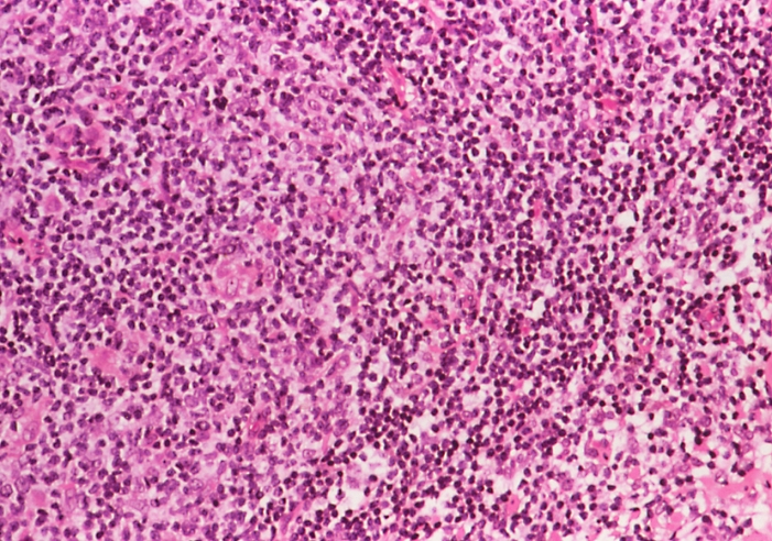Low grade non-Hodgkin's lymphoma. Coloured light micrograph (LM) of a section through lymph node lymphoid tissue with follicular B-cell lymphoma, a type of low grade non-Hodgkin's lymphoma (cancer). In this, the cancerous B-cells (B-lymphocyte white blood cells) form into follicle-like groups (not visible with this stain). This lymphoma has a low malignancy, causing diverse symptoms including lymph node enlargement, headache and skin ulceration. Treatment is by radiotherapy, anti-cancer drugs and, if necessary, bone marrow transplant. Lymph nodes filter harmful organisms from tissue fluid. Haemotoxylin and Eosin stained cells. Magnification: x200 at 35mm size.