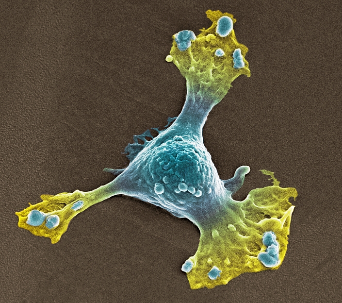 Skin cancer cell. Coloured scanning electron micrograph (SEM) of a melanoma cancer cell. This cancer arises from the skin's melanocytes, the cells that produce the pigment (melanin) that give skin its colour. Melanoma is an aggressive cancer that often spreads (metastasises) to other tissues of the body. The long cell process seen here help the cell to move. Once the cancer has spread the prognosis is poor. The main cause of melanoma is exposure to ultraviolet radiation in sunlight.