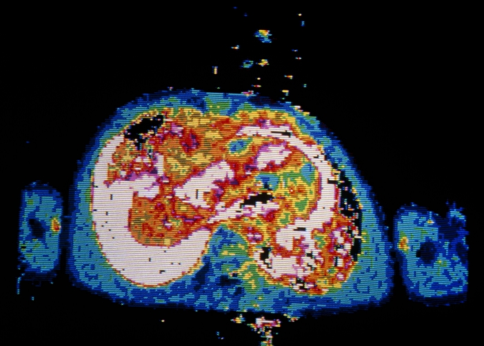 False colour nuclear magnetic resonance (NMR) image of a transverse section through the chest of a person suffering from Hodgkin's disease, showing massive pleural effusion and pericardial effusion. Pleural effusion involves the introduction of fluid into the pleural cavity surrounding the lungs, and appears as the large white areas at bottom left & top right (ie both lungs are affected). Pericardial effusion means fluid accumulation in the pericardium (the membranous sac surrounding the heart), and is represented by the central white area. Both types of effusions occur in advanced cases of Hodgkin's disease, a cancer of the lymphatic system.