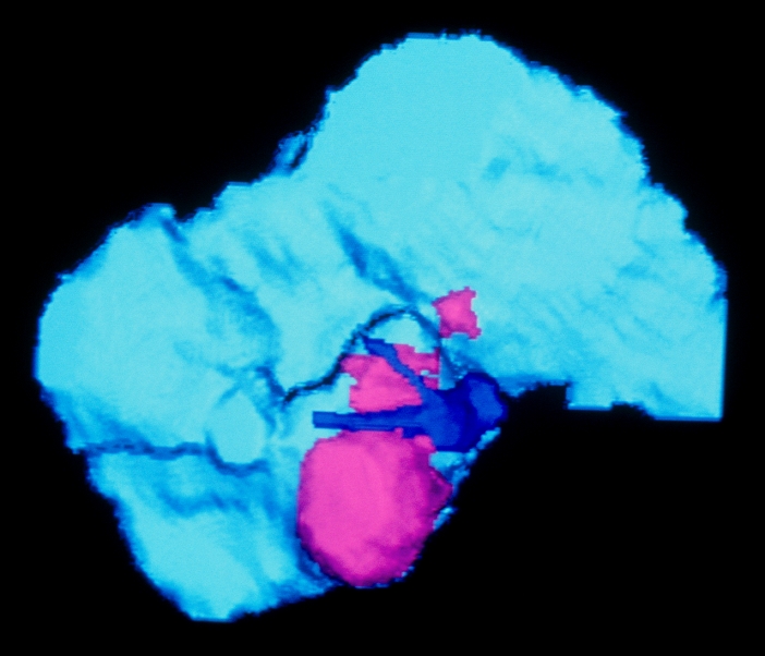 False-colour three-dimensional image revealing a cancerous tumour (purple) of the liver (blue), assembled from a series of conventional computed tomography (CT) scans. The liver is the site of both primary and secondary (metastases) cancers. Hepatoma (hepatocellular carcinoma) is the most common primary cancer & is associated with pre- existing cirrhosis & hepatitis B virus infection. Surgical resection (removal of various sections of the organ) offers the only means of a cure at present. Imagery of this type might be used to determine the position & size of the tumour, to indicate if any type of resection is appropriate. Blue structure is 'veine sus-hepatique'.