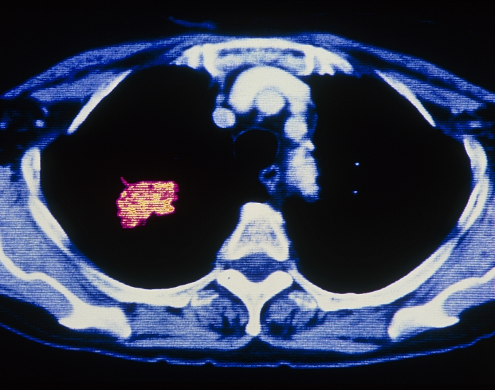 Lung cancer. Coloured Computed Tomography (CT) scan of an axial section through the human chest, showing cancer of a lung. At lower centre is a white triangular bone of a vertebra. Dark lung fields are seen within the chest. In the left lung (right on image) is a malignant tumour (pink). Lung cancer is one of the most common forms of cancer. As here, it is commonly associated with cigarette smoking. It may spread locally to tissues surrounding the lungs or to other parts of the body such as the liver, brain and bones. Treatment may involve anticancer drugs or radiotherapy. Surgery may be needed to excise the tumour, or remove the lung. (pneumonectomy).