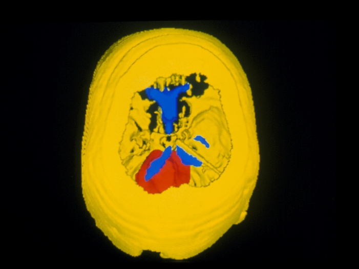 Medulloblastoma brain tumour. Colour 3-D computed tomography brain scan showing a medulloblastoma tumour (red). Image processing techniques have been used to cut away part of the skull. The blue structures are the fluid-filled ventricles in the centre of the brain. Medulloblastomas are malig- nant tumours that arise from the cerebellum of the brain that controls posture, balance and coordination. They are most common in children and tend to grow rapidly, spreading across the brain and spinal cord. Symptoms include headache, vomit- ing and clumsy gait. Treatment, which involves anticancer drugs, radiotherapy and surgery, often extends survival by five years or more.