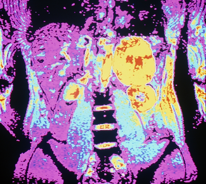 Cancer of the kidney. Coloured MRI (magnetic resonance imaging) scan of the abdomen showing a large malignant tumour (yellow, right) on a kidney. The scan shows a vertical 'slice' through the patient's abdomen. The pelvic area is at the bottom and parts of the arms appear in the upper left and right. The kidneys are the small, round yellow structures at left and right of centre. Between them are the spinal vertebrae. Cancer of the kidney is a rare disease. Most cases are caused by renal cell carcinoma, which is usually fatal as the tumour has often spread to other parts of the body by the time symptoms appear.