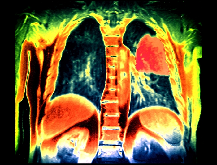 Lung cancer. Coloured magnetic resonance imaging (MRI) scan of a coronal (frontal) section through a patient's chest, showing a malignant tumour (red, upper right) in the left lung. Cancer cells divide rapidly and chaotically. They may clump to form tumours (as seen here), which invade and destroy surrounding tissues. Lung cancer causes a cough, chest pain, shortness of breath and weight loss. If the cancer has not spread (metastasised) to other tissues then the tumour may be removed surgically. Other treatments include chemotherapy (anti-cancer drugs) and radiotherapy.