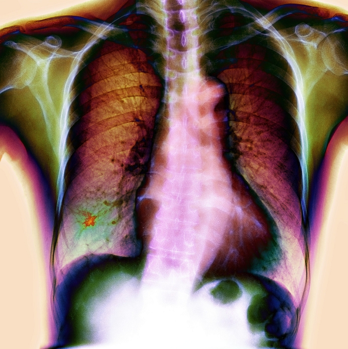 Lung cancer. Coloured chest X-ray with a bronchial carcinoma (red/green, lower left) in the patient's lower right lung. The heart (red, lower right) is obscured by the sternum in front and spine behind (white). The shoulder and rib bones are also seen, as well as the upper abdomen. This is a carcinoma, a malignant growth (cancer) of epithelial tissue, the tissue that lines the skin and the inside of the airways (bronchioles) of the lungs. It is caused by atmospheric pollution and primarily by smoking, causing coughing and breathlessness. Radiotherapy and surgery are suitable for some lung cancers, but the prognosis can be poor.