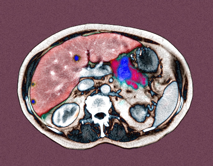 Metastatic pancreatic cancer. Coloured axial computed tomography (CT) scan showing cancer (blue dots) in the pancreas and liver. The front of the body is at top. The pancreas (dark pink) is to the right of the liver (pink). The cancer originated in the pancreas and has spread to the liver. The spread of cancer from one part of the body to another is called metastasis. If pancreatic cancer is diagnosed early it can be treated with surgical removal, or chemotherapy and radiotherapy. Once it has spread beyond the pancreas the prognosis is poor.