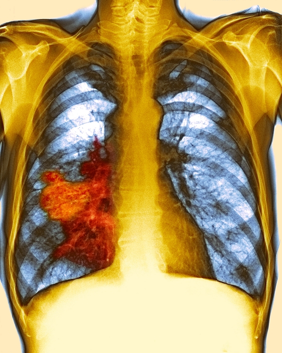 Lung cancer. Coloured chest X-ray showing a large tumour (red) due to lung cancer in the middle lobe of the right lung. This form of cancer is also known as bronchial carcinoma. Lung cancers are most often caused by cigarette smoking, exposure to asbestos, or other forms of pollution. Treatment includes radiotherapy, chemotherapy, and the surgical removal of all or part of the affected lung.