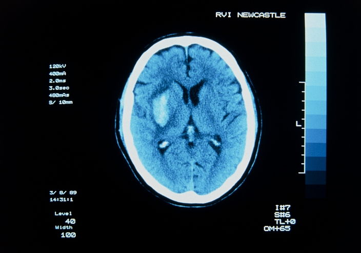 Computed tomography (CT) brain scan showing a cerebral (intracranial) haemorrhage (pale oval feature at left), the result of blood leaking from an artery into the surrounding brain tissue. Cerebral haemorrhages are often caused by arterial degeneration compounded by high blood pressure. Their severity & prognosis is dependent on size & location; symptoms vary from passing weakness or numbness to coma & death.
