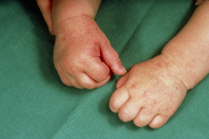 Reddening of an infant's hands due to eczema caused by an allergenic reaction to cow's milk. One theory holds that breast feeding conveys a significant degree of protection against eczema in young infants. This is based on an assumption that exposure to foreign food antigens in infancy, when a state of immune vulnerability exists, may result in allergic sensitization and the subsequent development eczema. Eczema is a general term for an inflammatory dermatitis of the skin that has no obvious external cause (as opposed to 'contact' or 'industrial' dermatitis) and is sometimes called endogenous or constitutional eczema.