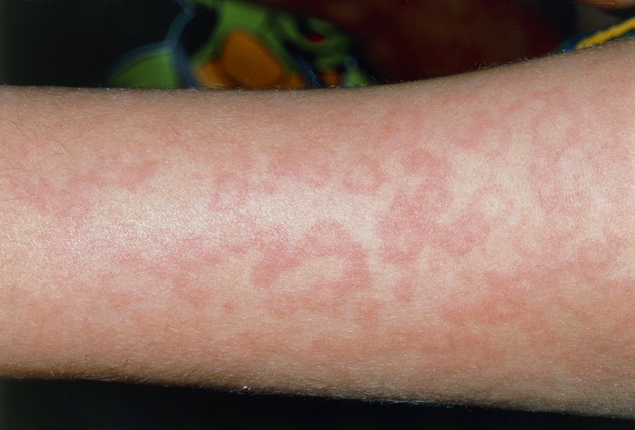 Erythema multiforme. View of a child's arm covered in round, red weals with pale centres. This condi- tion is called erythema multiforme which literally means 'skin redness of many varieties'. It is an acute inflammation of the skin & sometimes of the internal mucous membranes. A red,itchy rash erupts on the limbs & sometimes on the rest of the body. Erythema multiforme may be accompanied by fever, sore throat, headache or diarrhoea. This disease can occur as a reaction to certain drugs or may accompany viral infections. However, many cases (as here) have no apparent cause. Treatment includes corticosteroid drugs (anti-inflammatory) & treatment of any illness or reaction.