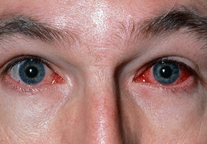 Viral conjunctivitis. View of inflamed eyes in a patient with viral conjunctivitis. The cornea is red & inflamed, particularly in the eye on the right. Conjunctivitis (pink eye) causes inflamma- tion of the conjunctiva (mucous membrane cover- ing the eye). Symptoms include redness, itchiness, irritation, discharge (pus in infective conjunct- ivitis) & occasionally photophobia (sensitivity to light). Conjunctivitis is caused by an infection, allergy or physical or chemical irritation. Treat- ment includes washing the eye with warm water to remove any pus, & eye drops containing an antibio- tic drug are given. However, viral conjunctivitis tends to get better without any treatment.