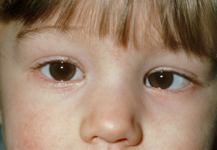 Convergent squint. Close-up of a child's face showing a convergent squint. The left eye (right) is turned inwards towards the other eye. A squint (strabismus) occurs when there has been a break- down in the development of the mechanism that al- igns the eyes. In young children, squints cause double vision. If left untreated, this can lead to permanent loss of sight in one eye, because the brain corrects the double vision by ignoring one of the eyes. Treatment includes surgery, correct- ive glasses, and wearing a patch over the dominant eye to maintain sight in the weaker eye.