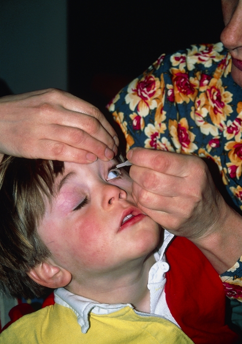 . Conjunctivitis. Mother applies eye-drops to her three year-old son's eyes to treat conjunctivitis. Conjunctivitis is an inflammation of the membrane (the conjunctiva) that lines the inside of the eyelids and covers the white of the eye. Allergic conjunctivitis can be a reaction to wearing contact lenses, or caused by environmental factors such as pollen, pollution or cigarette smoke. Antihistamine eyedrops, as in this case, can be given as treatment. MODEL RELEASED