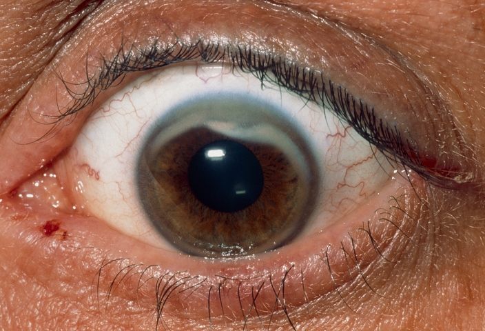Keratitis. Close up of a 41 year-old female patient's eye with a light, transparent membrane covering part of the eyeball. This is an inflammation known as keratitis, in this case caused by a contact lens problem. Keratitis affects the cornea, the tough outer coating of the eyeball. Symptoms include eye pain, excessive watering, blurring of vision and sensitivity to bright light (photophobia).