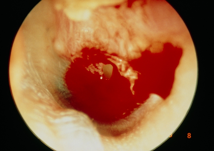 Perforated eardrum, the result of trauma from over-zealous use of a 'cotton bud', a type of cotton swab on a short stick, in cleaning wax from the ear. The perforation is surrounded by fresh blood from a skin cut in the ear canal. Uncomplicated perforations of the eardrum tend to heal naturally over a period of one month. Any slight deafness is transient.