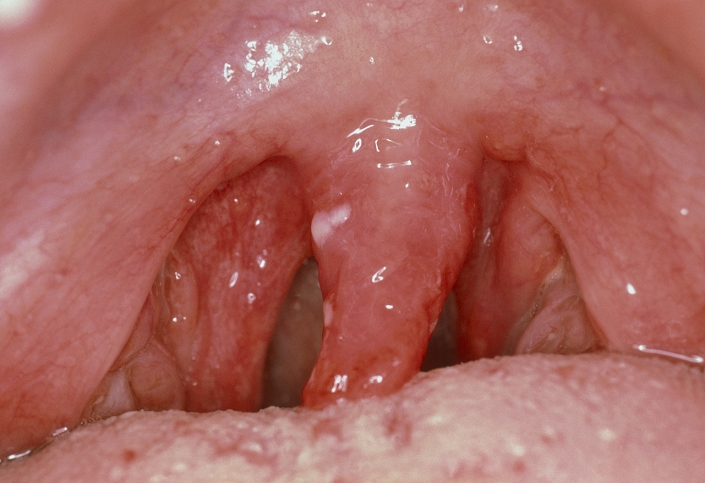 Viral pharyngitis. Close up of inflamed, pus- covered tonsils in a patient with a throat infection (or pharyngitis) caused by a non- specific virus. Viral infections such as glandular fever or influenza are caused by the Epstein-Barr virus, influenza virus, or cytomegalovirus. Once in the body the virus multiplies inside lymphocyte white blood cells. Symptoms of glandular fever include high fever, sore throat and swollen lymph nodes, particularly in the neck. Most patients recover from glandular fever within 4-6 weeks but frequently feel tired and run-down for a further two or three months.