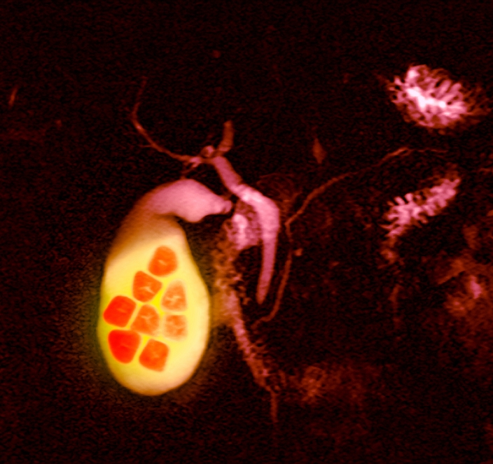 Gallstones. Coloured MRI (magnetic resonance imaging) scan of gallstones (red, left) in the gallbladder (yellow), a condition known as cholelithiasis. Gallstones are commonly hard deposits of cholesterol that form due to an imbalance between bile and cholesterol levels. Stones can also arise from bilirubin and calcium salts found in bile. Gallstones can cause sharp pain in the abdomen and may lead to infection. The gallbladder is a small organ that stores bile produced by the liver until it is needed. The bile is released during digestion to emulsify fats. Gallstones are most common in obese people and the elderly.