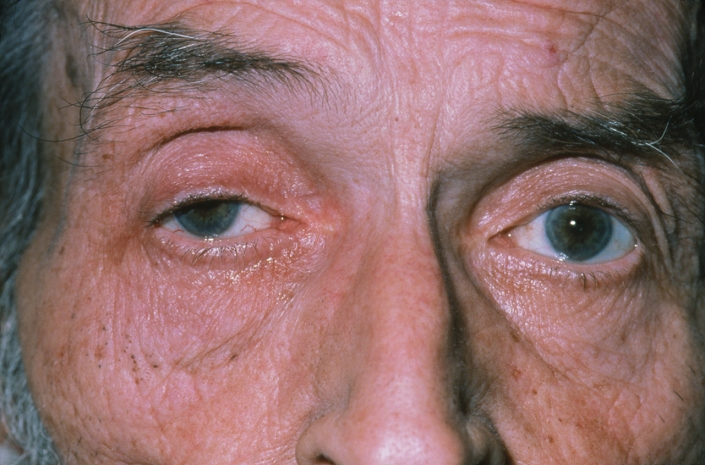 Horner's syndrome. The face of an elderly man showing Horner's syndrome - a group of physical signs that affect one side of the face only as a result of damage to the autonomic nervous system. Horner's syndrome includes a drooping eyelid, con- stricted pupil, and absence of sweat from one side of the face. These signs often result from nerve damage in the lower neck, and may be the first indication of a serious disease. In this case the condition resulted from cancer of the bronchus (a type of lung cancer). Both pupils are constricted here due to the use of opiate drugs to control pain caused by the cancer.